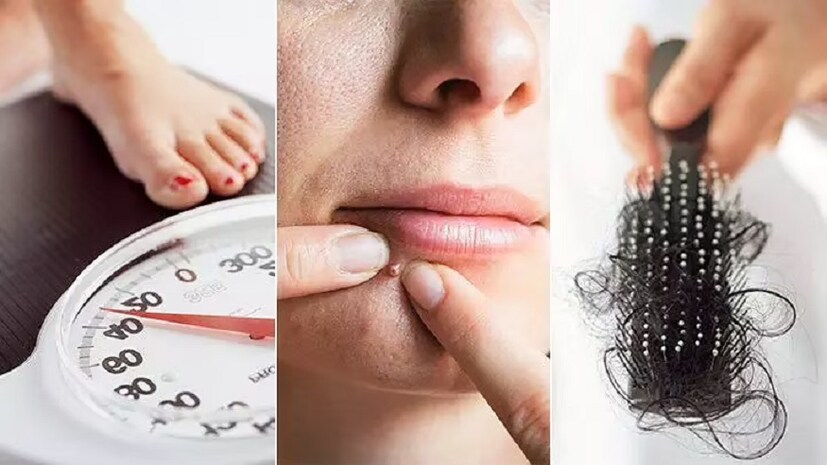 এক্ষেত্রে অ্যাকানথোসিস নিগ্রিক্যানস (Acanthosis Nigricans) নামে একটি স্কিন ডিজ-অর্ডার দেখা যায়। ত্বকের ভাঁজে ভাঁজে, বিশেষ করে বগল, ঘাড় বা থাইতে এই ধরনের সমস্যা দেখা যায়। এই ধরনের সমস্যা থেকে বাঁচতে ওজন কমানোর পরামর্শ দেওয়া হয়ে থাকে। লো গ্লাইসেমিক খাবার, নিয়মিত শরীর চর্চার কথা বলা হয়। প্রয়োজনে TCA ট্যাবলেটও দেওয়া হয়।