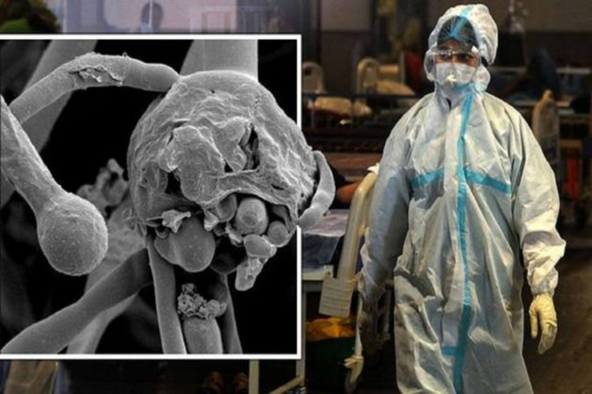 Black Fungus In Bengal : পশ্চিমবঙ্গেও ছড়িয়ে পড়ল ব্ল্যাক ফাঙ্গাস, ৫ জনের শরীরে মিলল সংক্রমণ!