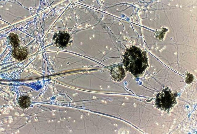 • এ ছাড়াও কারও নিউমোনিয়া হয়ে থাকলে তাঁর ক্ষেত্রে এই ছত্রাকে আক্রান্ত হওযার সম্ভাবনা প্রচুর পরিমাণে বেড়ে যায় । তবে বিশেষজ্ঞরা বলছেন, সুস্বাস্থ্যের অধিকারী সাধারণ মানুষের আতঙ্কিত হওয়ার প্রয়োজন নেই । অযথা দুশ্চিন্তা করবে না ।