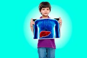 বিশ্বে প্রতি বছর ১০ কোটির বেশি মানুষ Hepatitis A রোগে আক্রান্ত হন, WHO-এর অনুমান