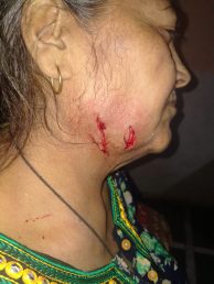 মহিলার গালে গভীর ক্ষত।