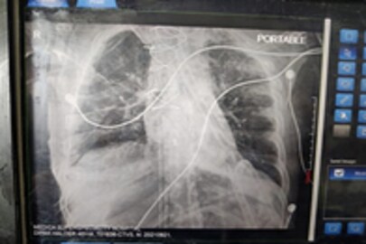 Lung Transplant