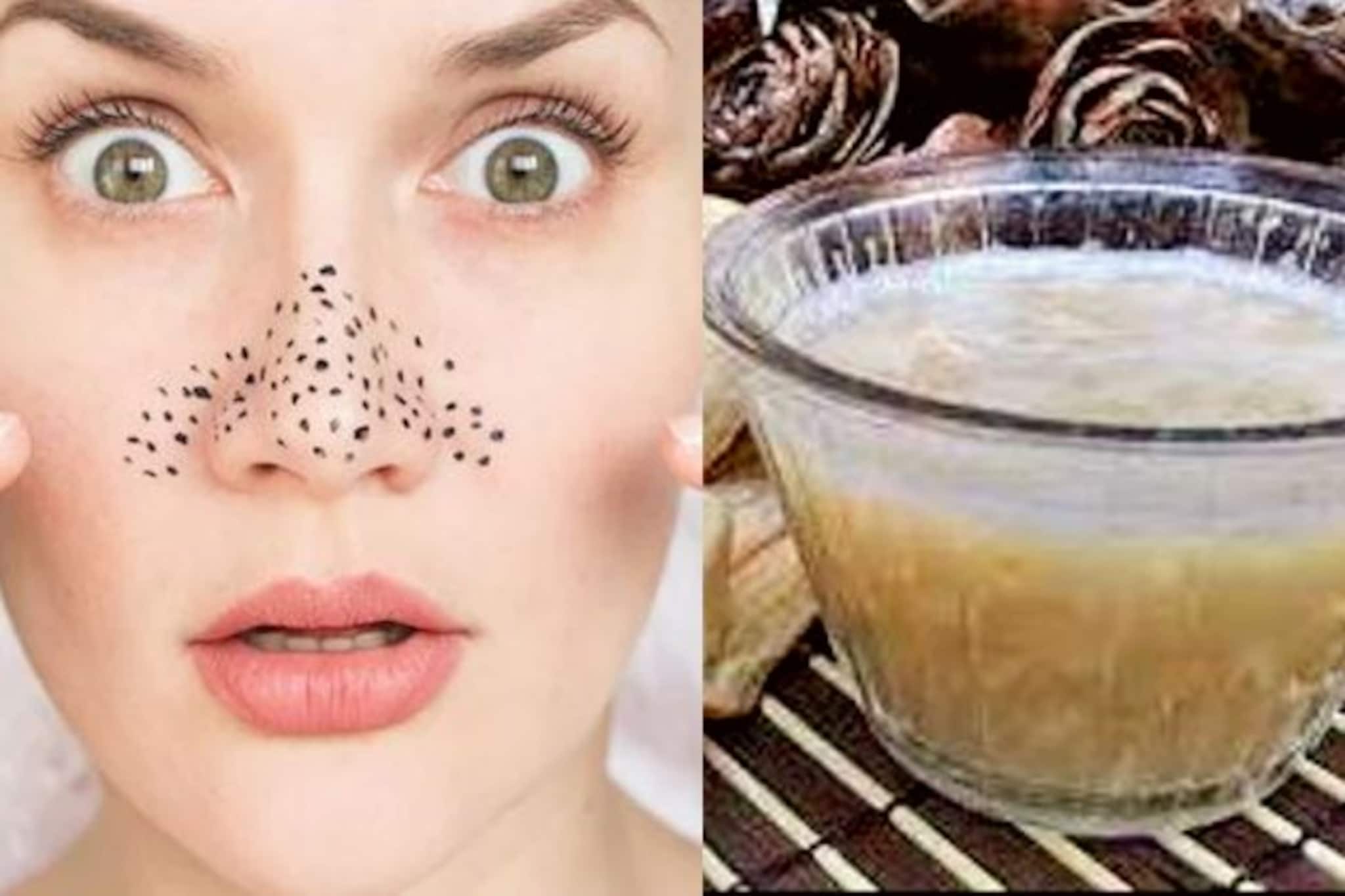 Durga Puja 2021 | skin care: সারা মুখ ভরে গিয়েছে ব্ল্যাকহেডসে? পুজোর আগেই ঘরোয়া পদ্ধতিতে সমস্যা দূর করুন