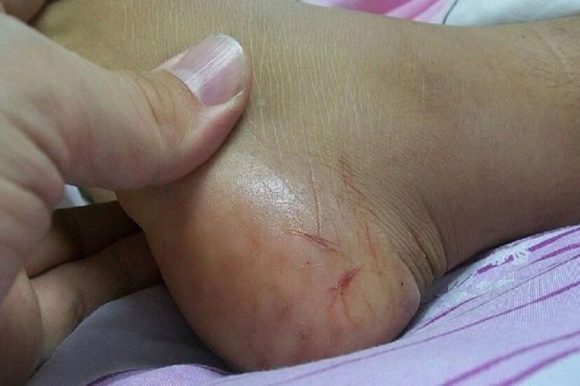 #হাবড়া: দীর্ঘদিন ধরেই হাবড়া অশোকনগর এলাকায় বেড়েছে সাপের উপদ্রব। বহু জায়গা থেকেই গত কয়েকদিনে উদ্ধার হয়েছে বেশ কয়েকটি বিষধর সাপ। সাপে কামড়ানো রোগীদের চিকিৎসার সুবিধার্থে সতর্কীকরণ ও প্রচার করা হয় প্রশাসনের তরফ থেকে। (প্রতীকী চিত্র) #হাবড়া: দীর্ঘদিন ধরেই হাবড়া অশোকনগর এলাকায় বেড়েছে সাপের উপদ্রব। বহু জায়গা থেকেই গত কয়েকদিনে উদ্ধার হয়েছে বেশ কয়েকটি বিষধর সাপ। সাপে কামড়ানো রোগীদের চিকিৎসার সুবিধার্থে সতর্কীকরণ ও প্রচার করা হয় প্রশাসনের তরফ থেকে। (প্রতীকী চিত্র)