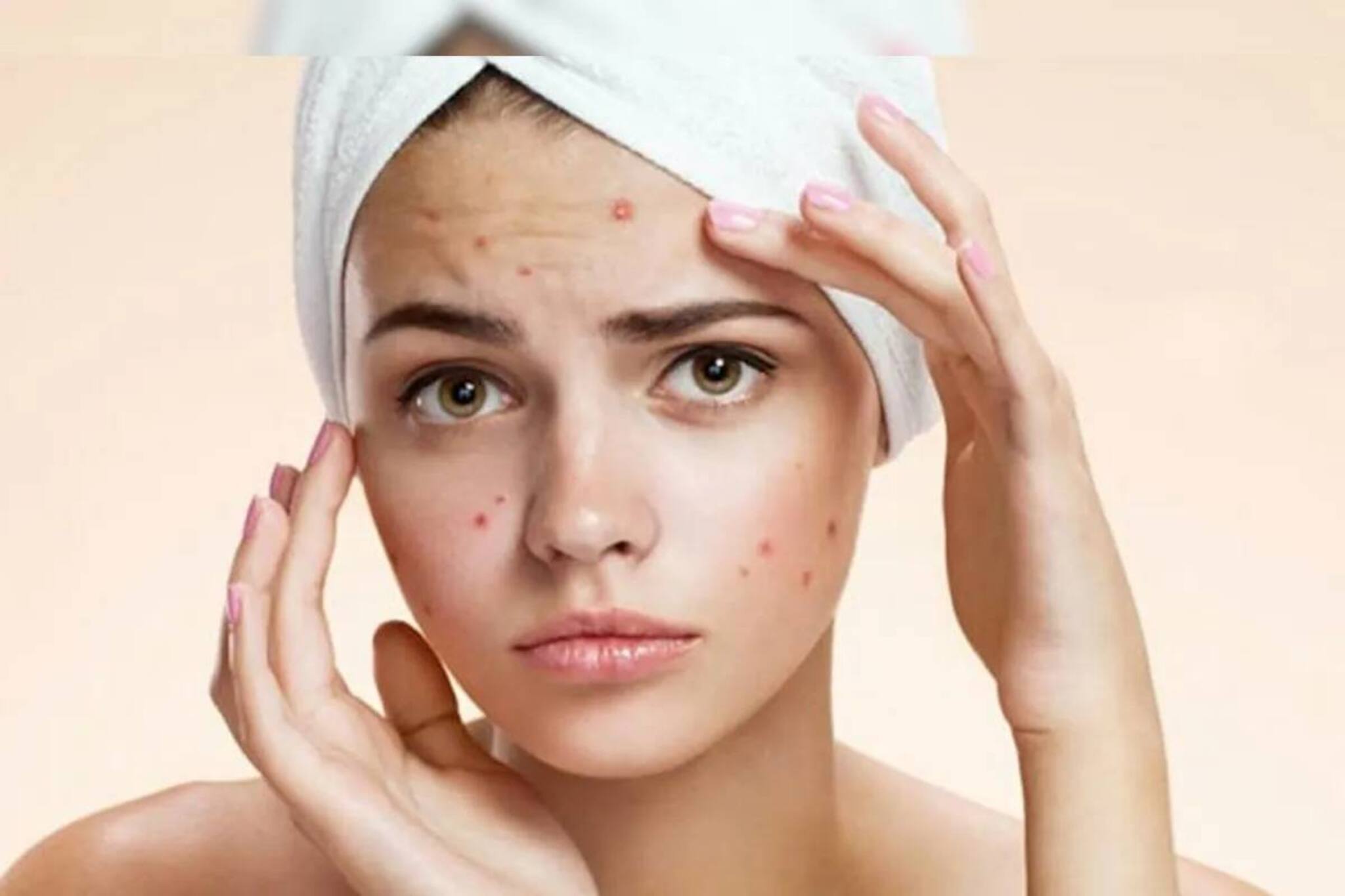 পুজোর সাজ মাটি করে দেবে গালের ব্রণ, শিখে নিন ব্রণ লুকিয়ে রাখার মন্ত্র