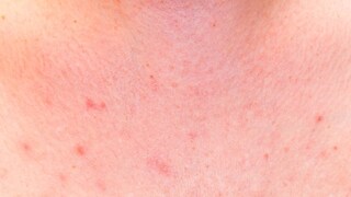 স্তনে লাল র্যাশ হয়েছে কি না দেখুন। কোনও ধরনের অস্বস্তি চুলকুনি দেখা দিলে দেরি করবেন না। স্তনে লাল র্যাশ হয়েছে কি না দেখুন। কোনও ধরনের অস্বস্তি চুলকুনি দেখা দিলে দেরি করবেন না।