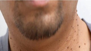 ঘরোয়া বেশ কিছু উপায়ে আঁচিল থেকে মুক্তি পাওয়া যায় (Home remedies to get rid from wart)