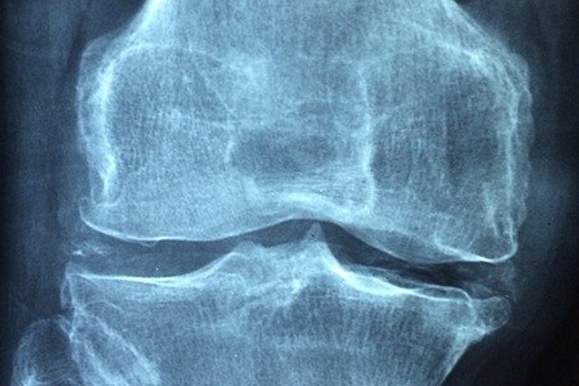 অস্টিওপোরোসিস (Osteoporosis)- অস্টিওপোরোসিস একটি হাড়ের রোগ। এটির কোনও লক্ষণ বা উপসর্গ দেখা যায় না, যতক্ষণ না কোনও ফ্র্যাকচারের মধ্য দিয়ে ধরা না যাচ্ছে। তাই ক্যালসিয়াম এবং ভিটামিন D সমৃদ্ধ খাবার খাওয়া নিয়মিত রুটিনে রাখা খুব প্রয়োজন। নিয়মিত চেক আপ করাও প্রয়োজন।