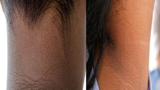 ঘাড়ের কালোভাব নিয়ে নাজেহাল। 