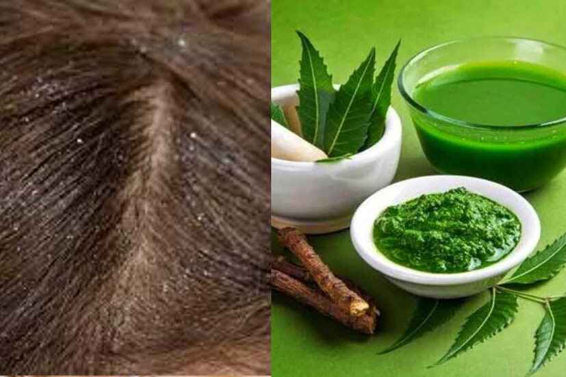 শীতের মরশুমে চুলের নানা কম সমস্যা দেখা যায় (Hair Care tips)। যেমন চুল মাত্রাতিরিক্ত রুক্ষ হয়ে যায়। পাশাপাশি স্ক্যাল্পে খুশকির (Dandruff) সমস্যাতেও ভোগেন অনেকেই। খুশকি যেমন চুলের গোড়ার ক্ষতি করে, তেমনই আবার সারা পোশাকে খুশকি ছড়িয়ে গেলেও দেখতে খারাপ লাগে। খুশকি দূর করতে নিম পাতা কার্যকরী। কিন্তু কী ভাবে ব্যবহার করবেন নিম পাতা দেখুন 