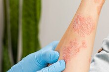 Psoriasis সারিয়ে নতুন বছরে পান নতুন জীবন, পথ দেখাবে কলকাতা!