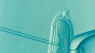 egg freezing at the age of 30-40 years, Know benifits and risk- Photo- Reppresentative 