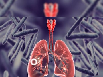 West Bengal Goverment is working for a mission to eleminate tuberculosis 