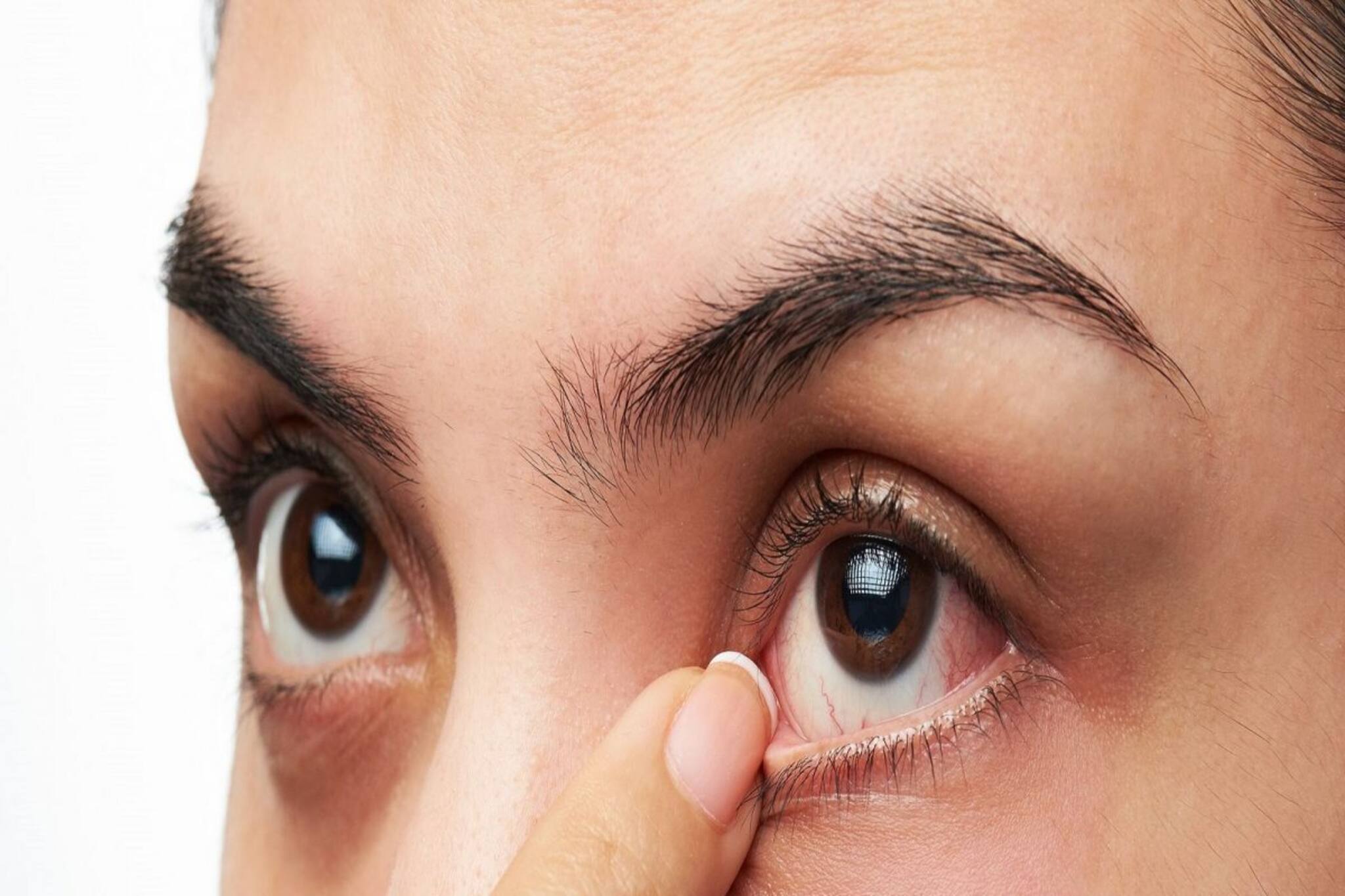 আচমকা চোখ লাল হয়ে জ্বালা ভাব? ওমিক্রনের এই উপসর্গ থেকে সাবধান!