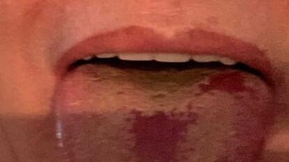 ক্যানসার চিকিৎসায় জিভের অর্ধেক অংশ নষ্ট হয়েছিল!কীভাবে সুস্থ হচ্ছেন,জানালেন মহিলা ক্যানসার চিকিৎসায় জিভের অর্ধেক অংশ নষ্ট হয়েছিল!কীভাবে সুস্থ হচ্ছেন,জানালেন মহিলা