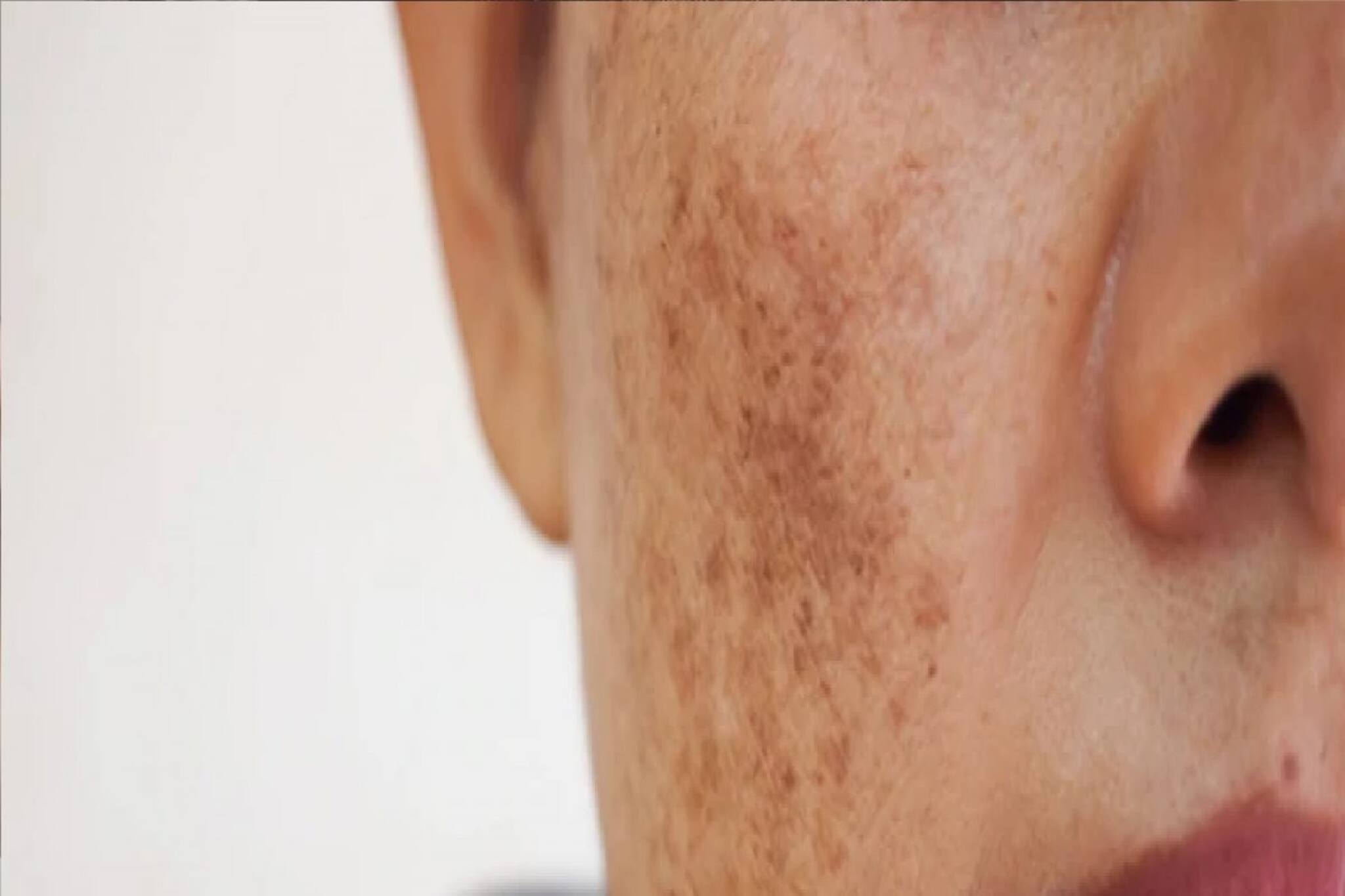 ত্বকে দেখা দিয়েছে ব্ল্যাকস্পট? দাগ নিয়ে হতাশ? রইল দাগ দূর করার সহজ উপায়...