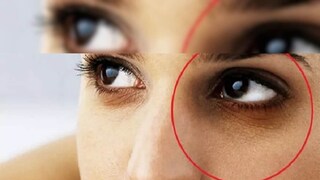 চোখের নীচে কালো দাগের সমস্যায় ভোগেন অনেকেই৷ চোখের নীচে কালো দাগের সমস্যায় ভোগেন অনেকেই৷