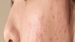 টি ব্যাগ ট্যান দূর করতে সাহায্য করে৷ টি ব্যাগ ঠান্ডা করে ত্বকের ট্যান পড়া অংশে প্রয়োগ করুন৷