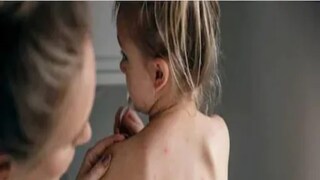 Chicken Pox Chicken Pox