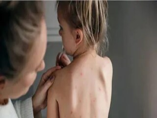 Chicken Pox