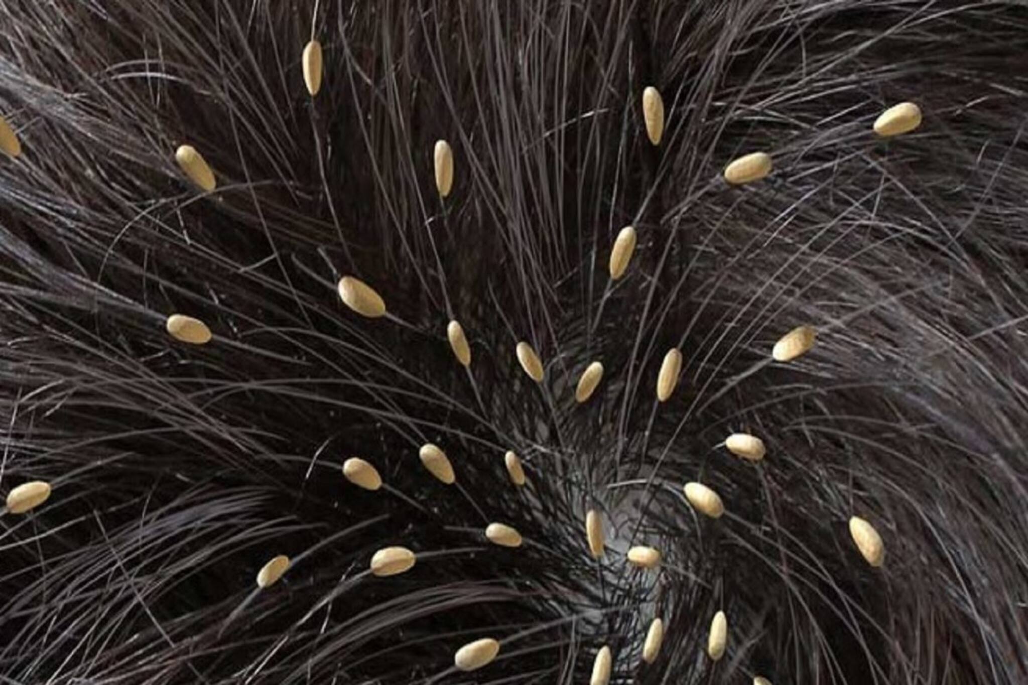 স্ক্যাল্প অথবা ঘাড়ে আচমকা চুলকানি হলেই সাবধান, হতে পারে উকুন!