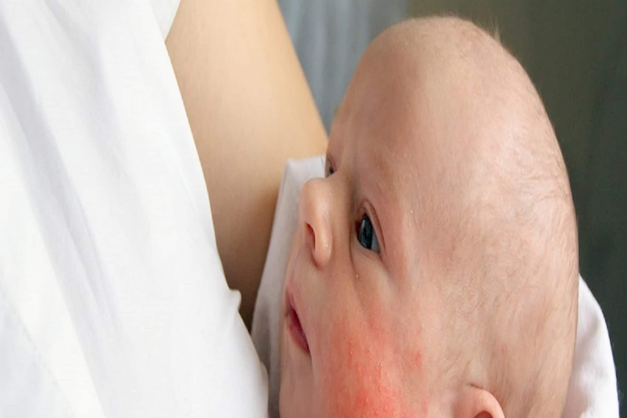 গরম পড়তে না পড়তেই সদ্যোজাতর গায়ে-মুখে র‍্যাশ? কীভবে মোকাবিলা করবেন? পড়ুন