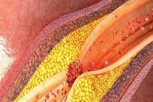 High Cholesterol Symptoms: বয়স যখন ২৫ থেকে ৩৫ শরীরের এই লক্ষণই বলে দেবে চারদিক থেকে ঘিরে ধরেছে হাই কোলস্টেরল