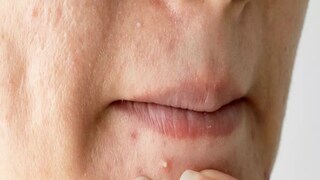 Pimple Problem Pimple Problem