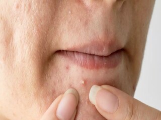 Pimple Problem