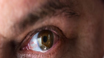 মানসিক চাপ, বিভিন্ন অনিদ্রাজনিত সমস্যা, নার্ভের সমস্যা চোখের পাতা কাপার কারণ হতে পারে৷ মানসিক চাপ, বিভিন্ন অনিদ্রাজনিত সমস্যা, নার্ভের সমস্যা চোখের পাতা কাপার কারণ হতে পারে৷