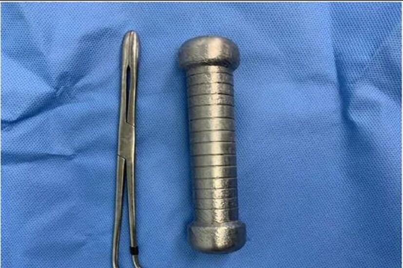 ইন্টারন্যাশানাল জার্নাল অফ সার্জারি কেস রিপোর্টে প্রকাশিত খবরে এই বিষয়টি সামনে এসেছে৷ ব্রাজিলের মুআউসের বাসিন্দা এক ব্যক্তির পেট ব্যাথা হয়৷ তারপর তাঁকে হাসপাতালে পাঠানো হয়৷ যেখানে চিকিৎসকরা তাঁর এক্সরে করানোর সিদ্ধান্ত নেন৷ সেখানে সেই বক্তি প্রচপর নাটক করে৷ ওই ব্যক্তি এক্সরে করানোর জন্য প্রস্তুত ছিল না৷ যদিও চিকিৎসকরা রিপোর্ট দেখে অবাক হয়ে যায়৷ ওই ব্যক্তির মলাশয়ে ২ কিলোর ডাম্বেল ঢুকেছিল৷
