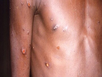 Monkeypox Disease