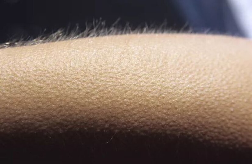 Goosebumps কি হয়? ত্বক যখন ঠান্ডার সংস্পর্শে আসে, তখনই সেই ঠান্ডার হাত থেকে ত্বককে বাঁচাতে নিজে থেকেই একটা আবরণ তৈরি করে নেয় সে। সেই আবরণকেই আমরা কাঁটা বলে থাকি। আসলে এই কাঁটা দেওয়াও হরমোনের ব্যাপার। ঠান্ডা বা ভয়ের কারণে শরীরের হরমোনে উত্তেজনা দেখা দিলে তখনই ত্বক এই আবরণ তৈরি করে।