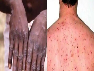 Monkeypox