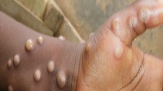 Monkeypox 