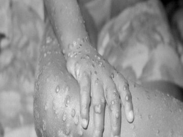 Monkeypox Virus