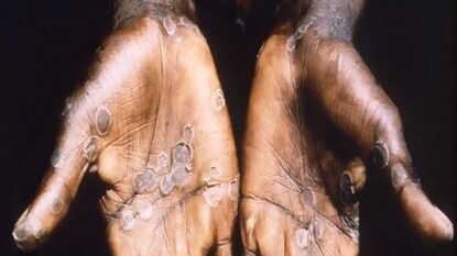 Monkeypox Monkeypox