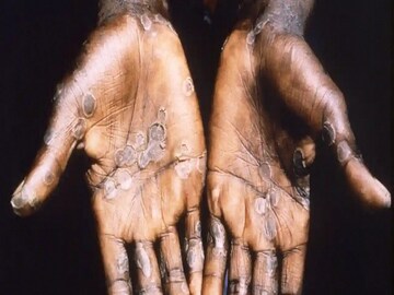 Monkeypox 