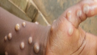 Monkeypox Symptoms Monkeypox Symptoms