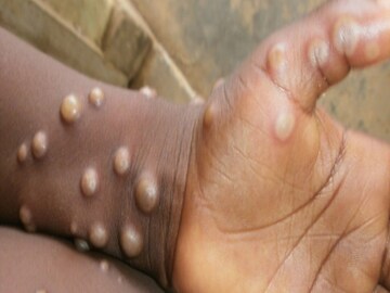 Monkeypox Symptoms