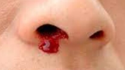 এই সমস্যার আর এক নাম হল এপিসট্যাক্সিস এই সমস্যার আর এক নাম হল এপিসট্যাক্সিস