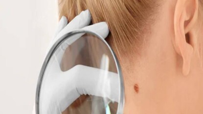 Skin Cancer Skin Cancer