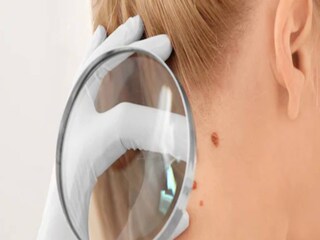 Skin Cancer