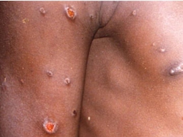 Monkeypox