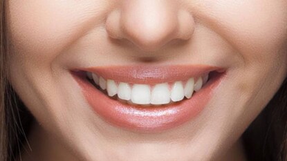 Teeth Whitening Teeth Whitening