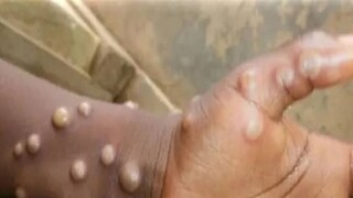 মাঙ্কিপক্স আতঙ্ক সতর্কতা রাজ্যে 