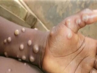 মাঙ্কিপক্স আতঙ্ক সতর্কতা রাজ্যে 