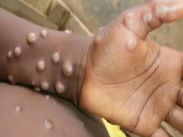 Monkeypox in India