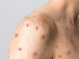 Monkeypox