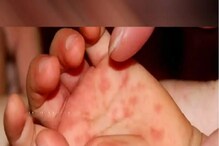 Kerala Tomato Flu: ফের রহস্যময় রোগ ভারতে! টমেটো ফ্লুতে আক্রান্ত ৮০ জন শিশু! কী এর উপসর্গ? Kerala Tomato Flu: ফের রহস্যময় রোগ ভারতে! টমেটো ফ্লুতে আক্রান্ত ৮০ জন শিশু! কী এর উপসর্গ?
